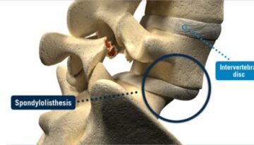 spondylolisthesis